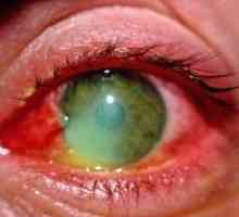 Изгаряния на очите от заваряване какво да правя и как да се предотврати?