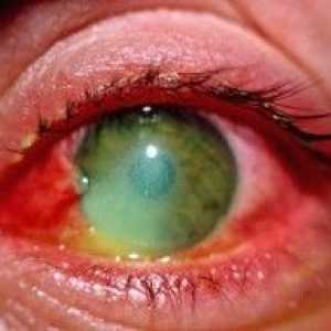 Изгаряния на очите от заваряване какво да правя и как да се предотврати?
